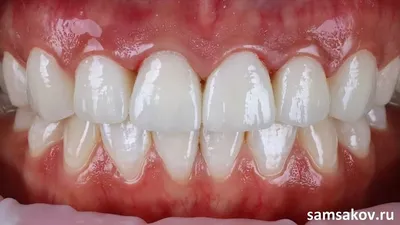 Если остался корень зуба - зуб можно полностью восстановить за 1,5 часа  вкладками и модулями Cerec