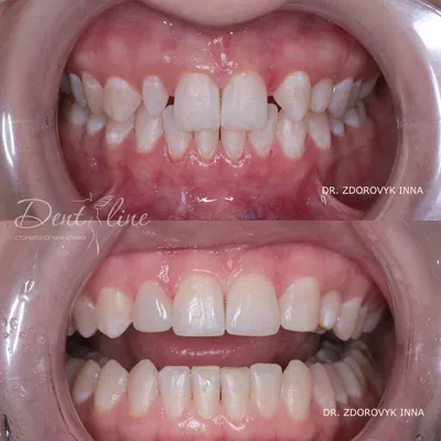 Почему возникают волнистые края у передних зубов? | Стоматология  Smile-at-Once | Дзен