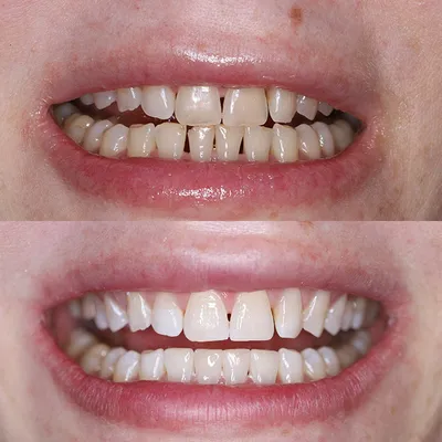 Диастема зубов - как убрать щель между зубами | SILK
