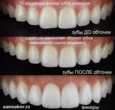 Художественная реставрация зубов в Москве: цены, фото до и после, отзывы |  Стоимость художественной реставрации зубов в клинике Seline