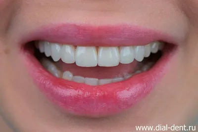 Большие зубы – причины и способы коррекции