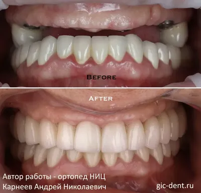 Установить виниры для зубов. Фото до и после, цена | Альянс  бьюти-ортопедов, Москва