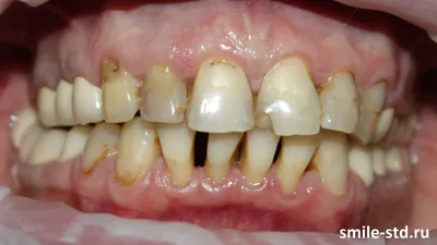 Как делаются виниры и как крепят виниры на зубы?
