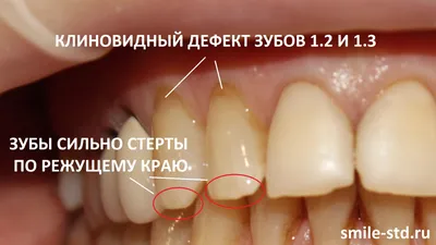 Можно ли носить виниры если нет зубов? | Блог | Стоматология «Дент Тайм»