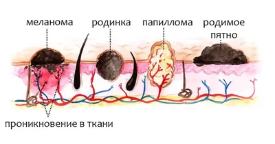 Невинные пятнышки или предвестники рака: что такое ВПЧ и чем папиллома  отличается от родинок - Видео