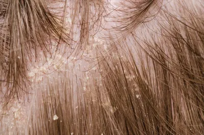 Жирная себорея – лечение жирной себореи кожи головы в Москве, цены –  An-Tech Labs