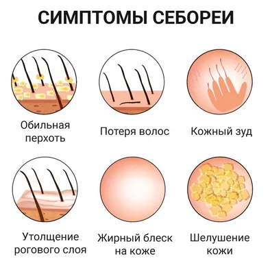 Себорейный дерматит - лечение себореи на голове, что это такое, причины