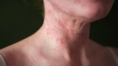 Почему у собак портится шерсть, что такое себорея и каковы её симптомы |  Hill's