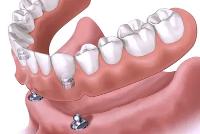 Съемные зубные протезы полной потере зубов в клинике Адалдент