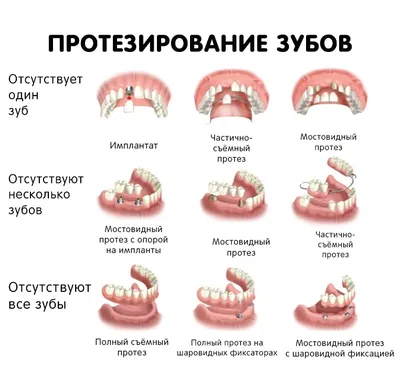 Съемные без акриловые протезы (Вертекс)