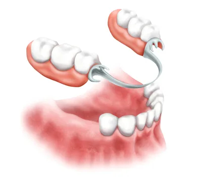 Съемные зубные протезы — цена в Москве в стоматологии OneDent.ru