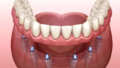 Съемные протезы - Стоматология СтомаЛюкс в Ульяновске