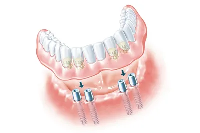 Полные и частичные акриловые съемные зубные протезы: плюсы и минусы,  изготовление и установка