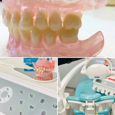 Съемные протезы для челюсти в Астане (Нур-Султан) – Установка съемных  зубных протезов в стоматологии «МЛД»