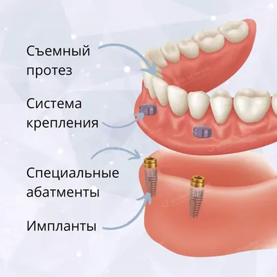 Верхний зубной протез: цена, виды протезов на верхнюю челюсть | НоваДент