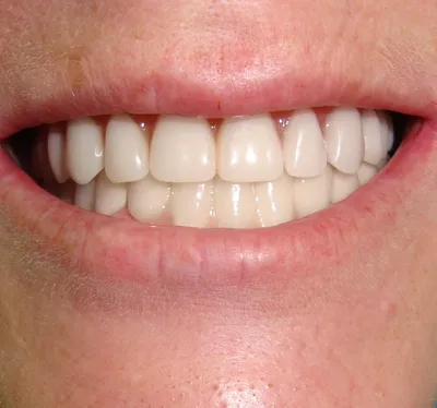 Съемное протезирование зубов в Уфе. Съемные протезы