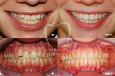 Сепарация зубов до и после фото фотографии