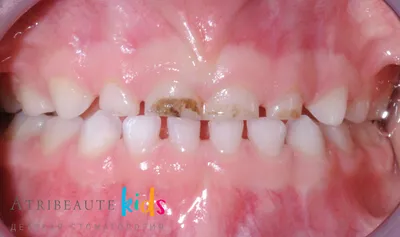 Серебрение зубов фото до и после фотографии