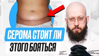 Что такое серома? Почему возникает серома? Профилактика серомы после  пластической операции - YouTube