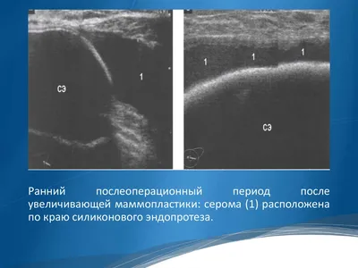 Серома после маммопластики. Что делать?! - PlasticRussia