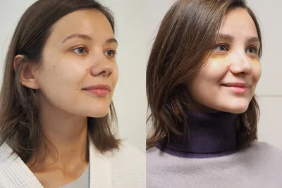 Новый нос от доктора Шихирмана. История Марины. Часть 1 | Beauty Insider