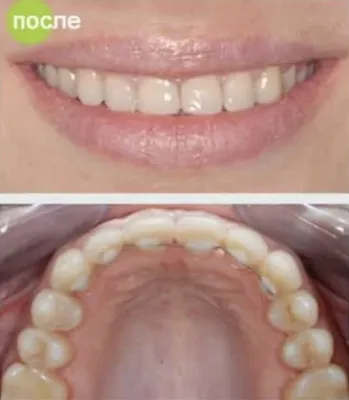 Шинирование зубов фото до и после фотографии