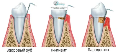 Шинирование зубов при пародонтите в стоматологии цены и фото