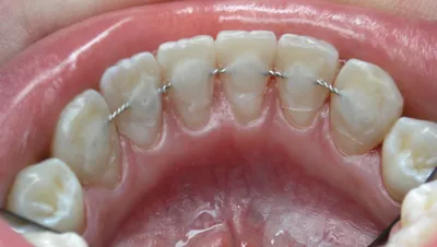 Что такое шинирование зубов и зачем нужна эта процедура?