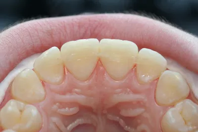 Что такое шинирование зубов и для чего оно применяется? | Стоматология  «Дентал Арт» | Дзен