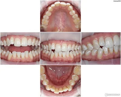 Шинирование зубов после брекетов - «Как на самом деле устанавливают  ретейнеры, на что они влияют, как выглядят (+фото до и после брекетов)» |  отзывы