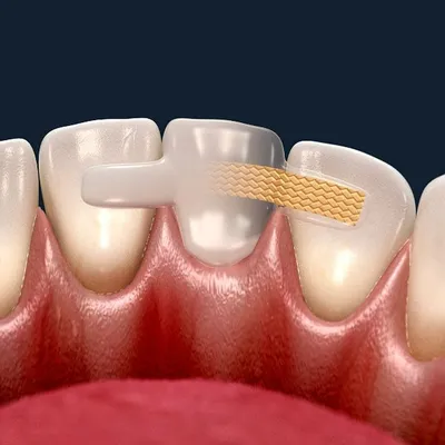 Шинирование зубов в стоматологии стекловолокном при пародонтите и  пародонтозе: процедура для подвижных зубов