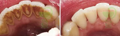 Имплантация зубов / протезирование (до и после)