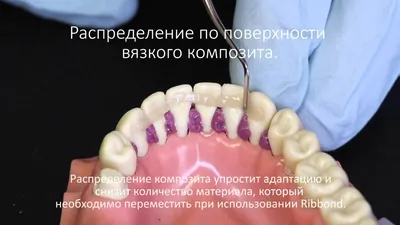 Шинирование зубов, цены. Шинирование подвижных зубов стекловолоконной  лентой в Минске