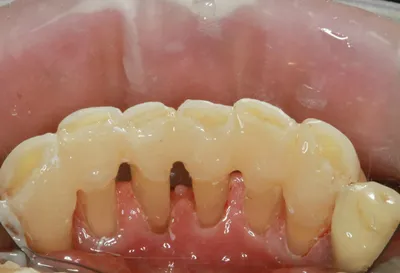 Шинирование зубов: что это такое, фото до и после