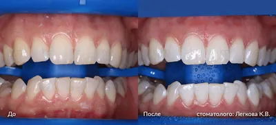 Шинирование передних зубов с целью профилактики выдвижения зубов, фото до и  после Уфа