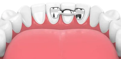 Шинирование зубов цены стекловолоконной лентой лечение десен