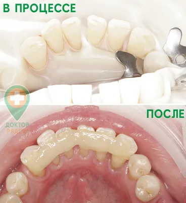 Фото до и после - Отбеливание зубов Zoom 4 - клиника Seline