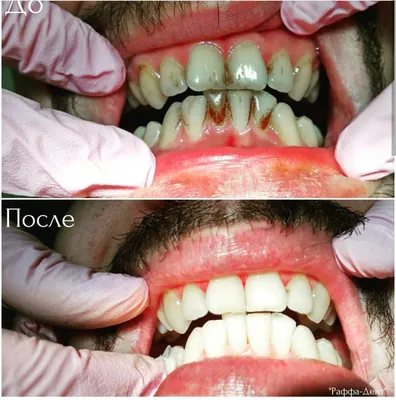Чистка зубов/гигиена (до/после)