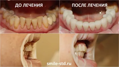 Установка брекетов до и после фото - Центр Семейной Стоматологии в Кожухово