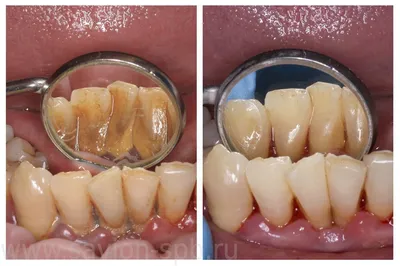 Пломбирование зуба: виды зубных пломб и процедура пломбирования  |Стоматология Раффа