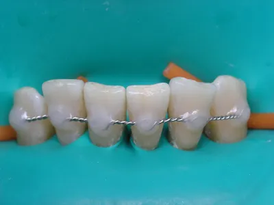 Чистка и отбеливание зубов фото до и после