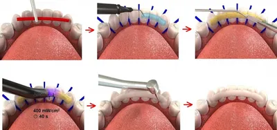 Шинирование зубов при пародонтите | Ревдинская стоматологическая поликлиника