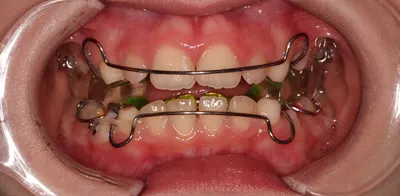 Профессиональное отбеливание зубов фото до и после - CrystalDent  стоматология - Голосеевский район Киева - Демеевская