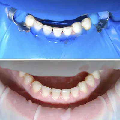 Реставрация зубов (до и после) - Работы стоматологов Центра Стоматологии и  Имплантологии