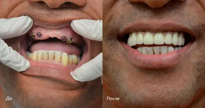 Фото до и после процедуры имплантации зубов all-on-4 в клинике Селин