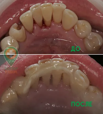 Коронки на зубах занизили прикус и разрушили другие зубы – клиника Smile  STD, Москва