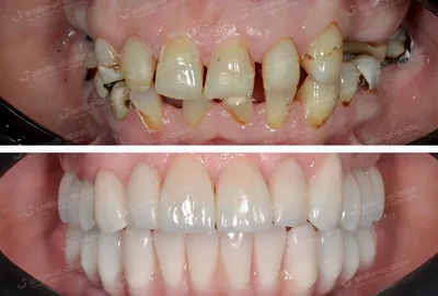 Шинирование переднего зуба (замещение временным зубом), фото до и после  Самара
