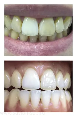 Установка виниров и коронок до и после в стоматологии Smile-at-Once в  Москве. Фото до и после