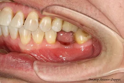 Фотографии до и после лечения зубов в Стоматологии ТариДент