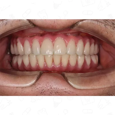 Фото до и после - Профессиональная гигиена зубов - клиника Seline